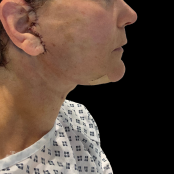 First-day-after-facelift-necklift